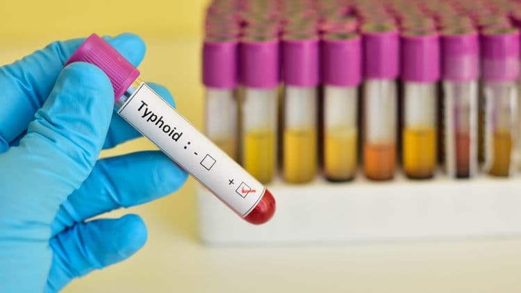 DOH: 280 kaso ng typhoid fever naitala sa NCMH
